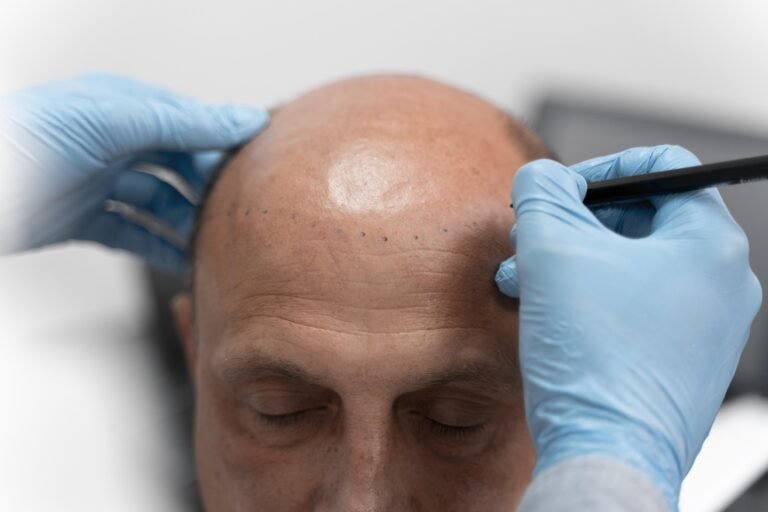 scalp micropigmentation in mumbai